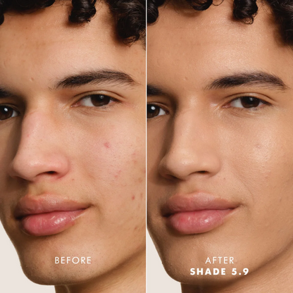 Before and after comparison of a person's face with acne, using a cosmetic product labeled 'Shade 5.9'.