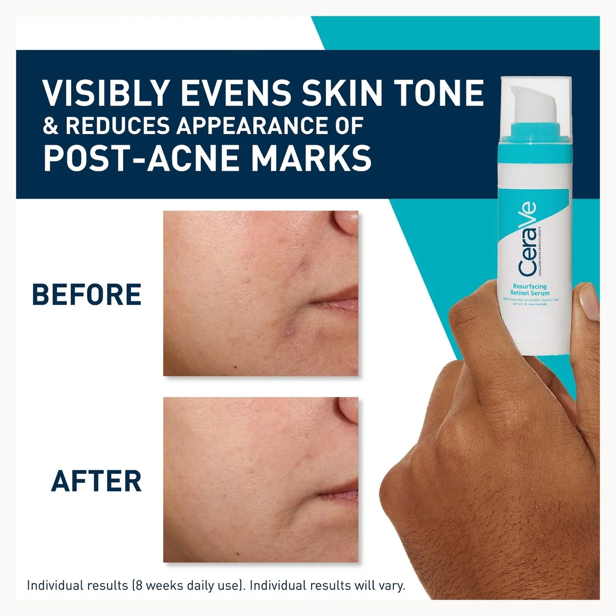 CeraVe visibly evens skin tone and reduces appearance of post-acne marks claim graphic, showing a hand holding the white and teal skincare bottle alongside before-and-after skin texture closeups.