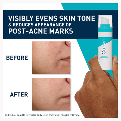 CeraVe visibly evens skin tone and reduces appearance of post-acne marks claim graphic, showing a hand holding the white and teal skincare bottle alongside before-and-after skin texture closeups.