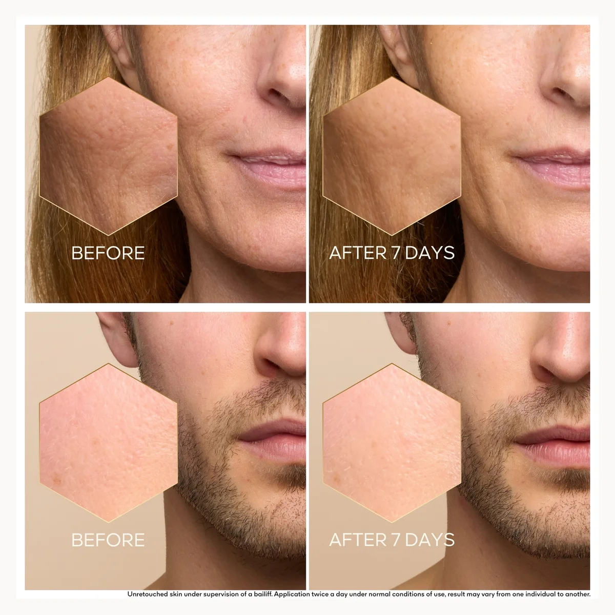 Before and after comparison of skin treatment on a person's face.
