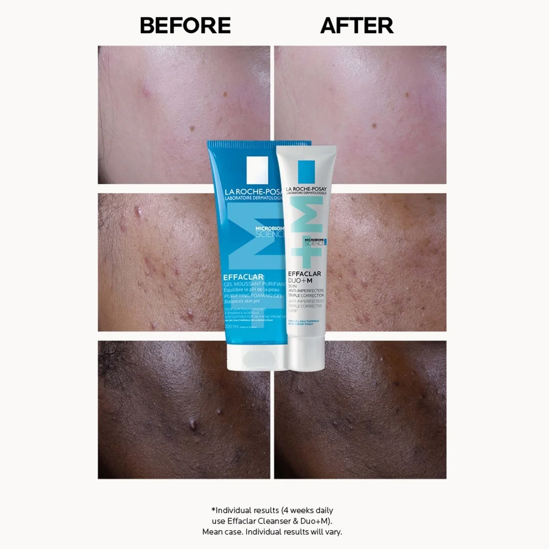 A before-and-after comparison collage showing skin results, with two skincare tubes centered over the split images. The tubes are blue and white with visible La Roche-Posay branding.
