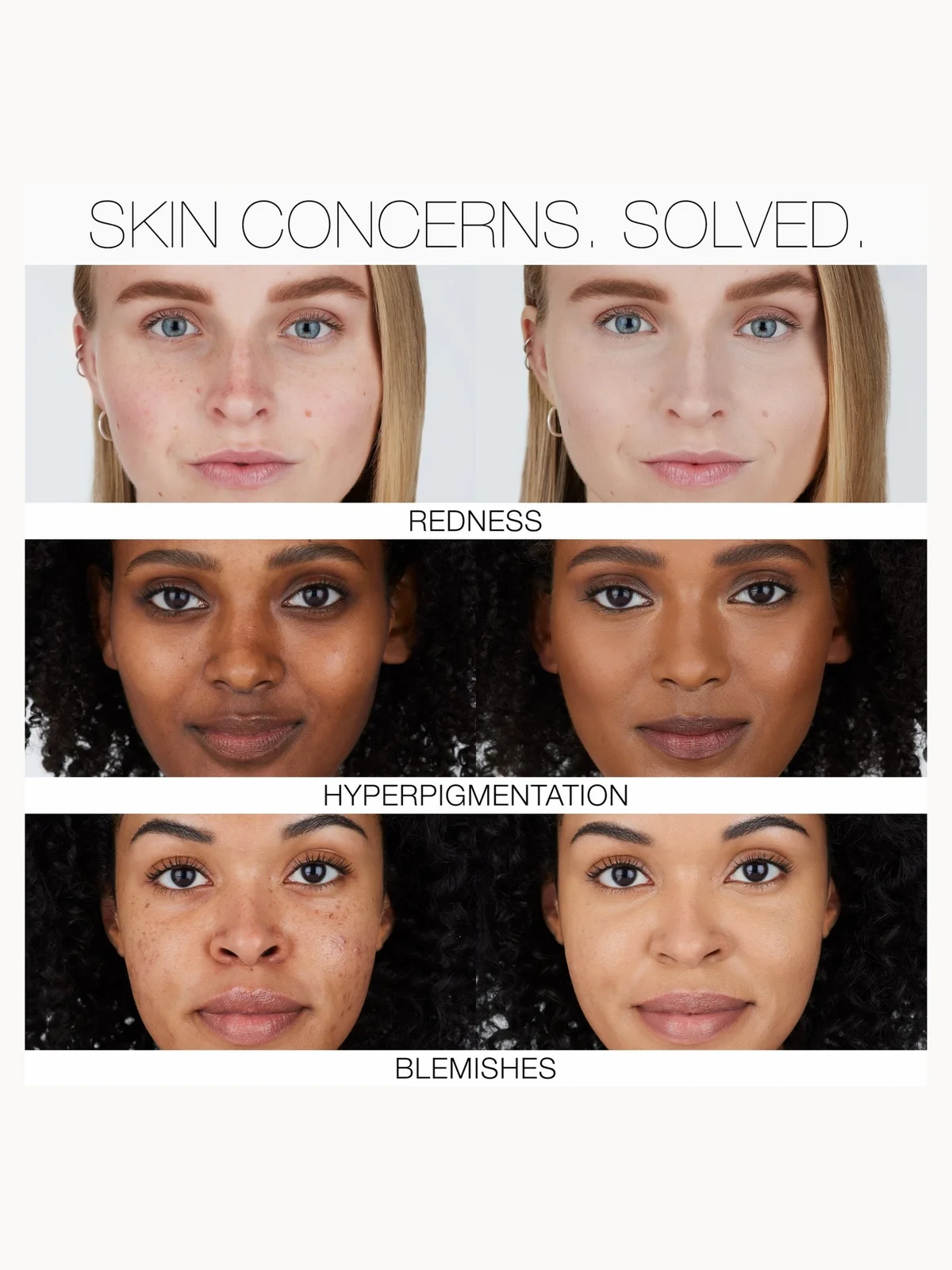 A before-and-after comparison graphic showing three skin concerns: redness, hyperpigmentation, and blemishes. The top row shows a lighter, clearer complexion labeled 'REDNESS,' the middle row shows darker hyperpigmented skin labeled 'HYPERPIGMENTATION,' and the bottom row shows clearer skin labeled 'BLEMISHES.