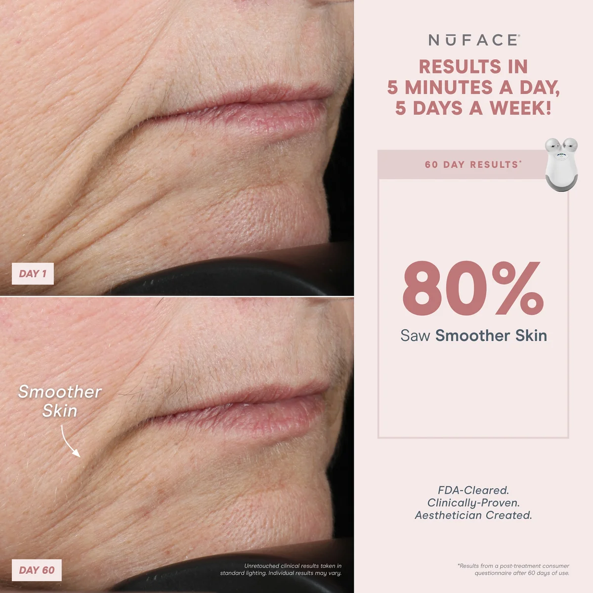 Before and after comparison of smoother skin with Nuface device results on a beige background.