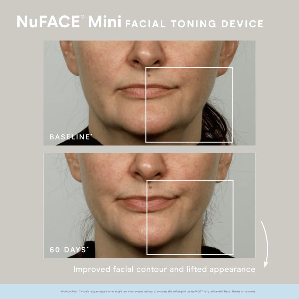 Before and after comparison of a woman's face using NuFACE Mini Facial Toning Device.