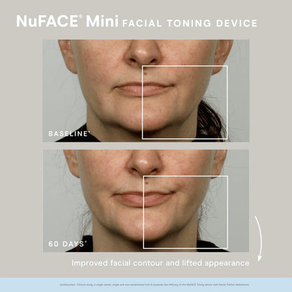 Before and after comparison of a woman's face using NuFACE Mini Facial Toning Device.