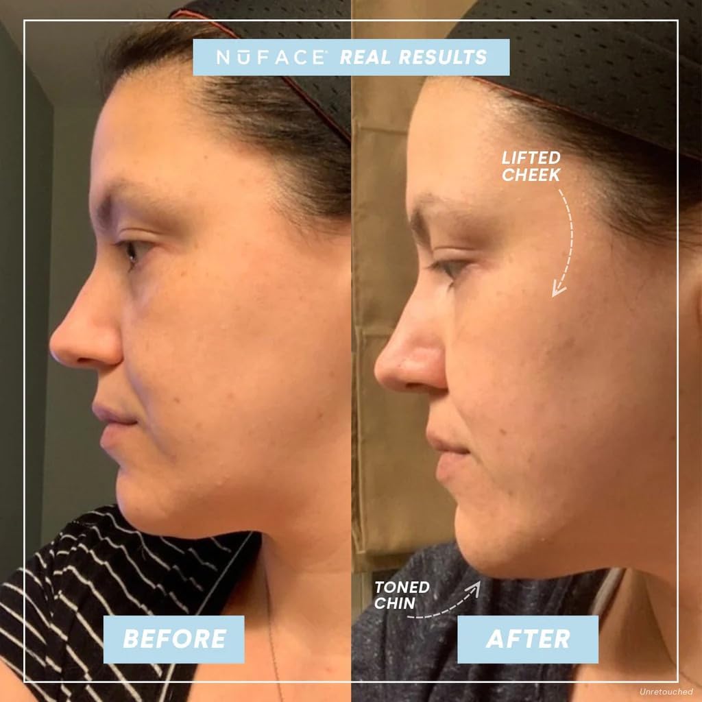 Before and after comparison of facial lifting with labeled areas on a person.